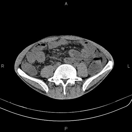File:Active crohn disease (Radiopaedia 87133-103397 Axial non-contrast 66).jpg