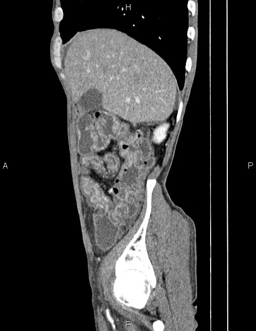 Active crohn disease (Radiopaedia 87133-103397 Sagittal C+ arterial phase 16).jpg
