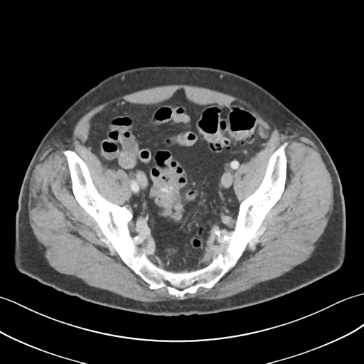 File:Active diverticular hemorrhage (Radiopaedia 39415-41725 Axial C+ portal venous phase 56).png