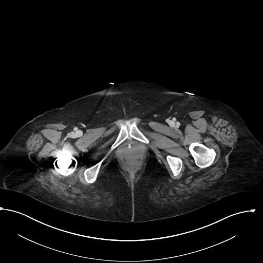 File:Active renal extravasation with large subcapsular and retroperitoneal hemorrhage (Radiopaedia 60975-68796 Axial 346).jpg