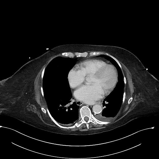 File:Active renal extravasation with large subcapsular and retroperitoneal hemorrhage (Radiopaedia 60975-68796 Axial 363).jpg