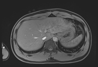 File:Active right ventricular cardiac sarcoidosis (Radiopaedia 55596-62100 Axial Post contrast Dixon 72).jpg