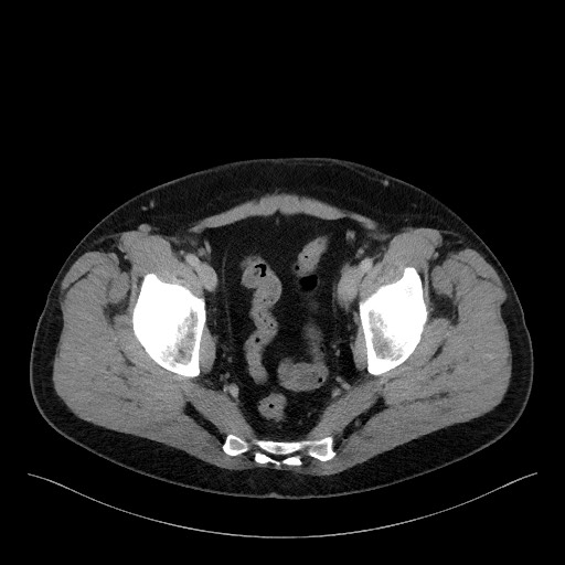 Acute-on-chronic pancreatitis (Radiopaedia 67286-76656 Axial C+ portal venous phase 73).jpg