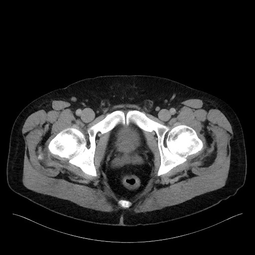 Acute-on-chronic pancreatitis (Radiopaedia 67286-76656 Axial C+ portal venous phase 81).jpg
