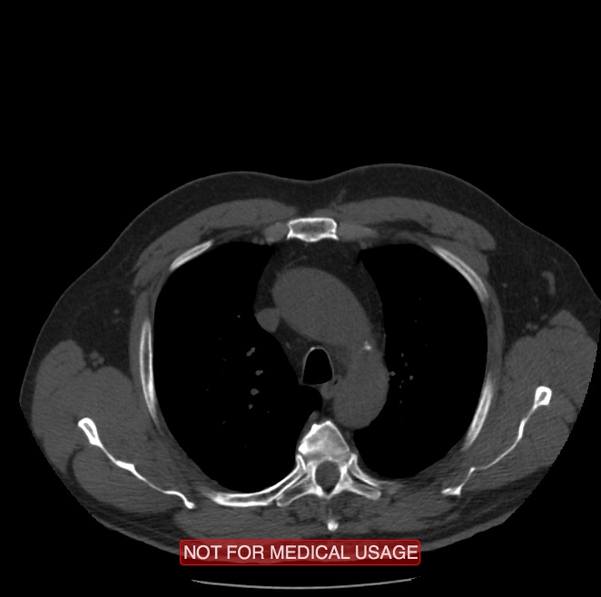 Acute aortic dissection - Stanford type A (Radiopaedia 40661-43285 Axial non-contrast 7).jpg