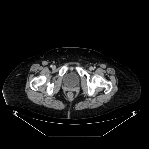 Acute appendicitis, heterotaxy syndrome (Radiopaedia 66884-76202 Axial C+ portal venous phase 128).jpg