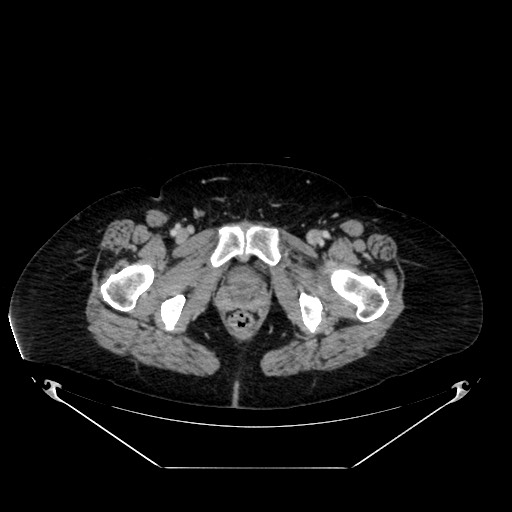 Acute appendicitis, heterotaxy syndrome (Radiopaedia 66884-76202 Axial C+ portal venous phase 131).jpg