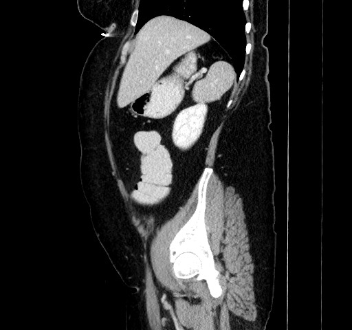 Acute appendicitis, heterotaxy syndrome (Radiopaedia 66884-76202 Sagittal C+ portal venous phase 40).jpg