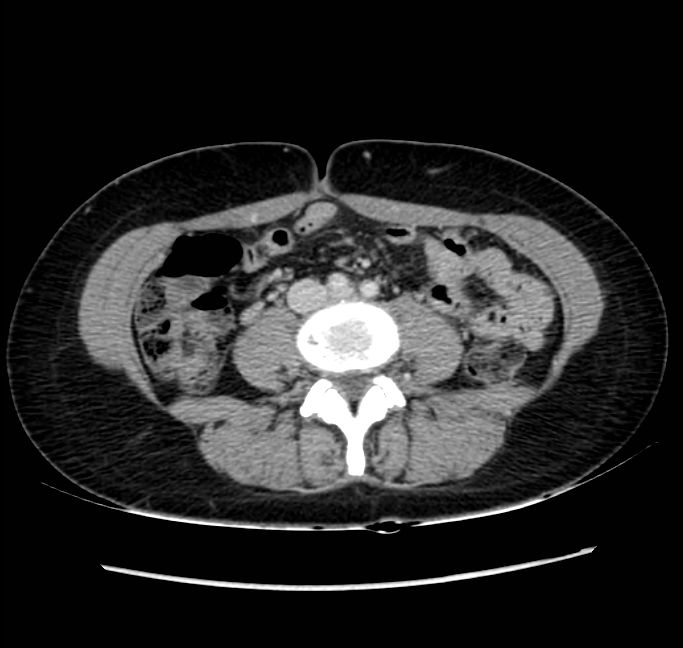 Acute appendicitis (Radiopaedia 22892-22918 Axial C+ portal venous phase 48).png