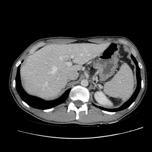 Acute appendicitis (Radiopaedia 27049-27227 Axial C+ portal venous phase 15).jpg