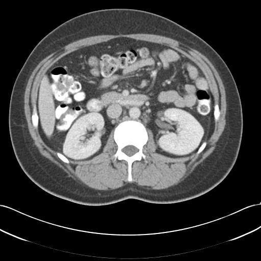 Acute appendicitis (Radiopaedia 30297-30934 Axial C+ portal venous phase 33).jpg