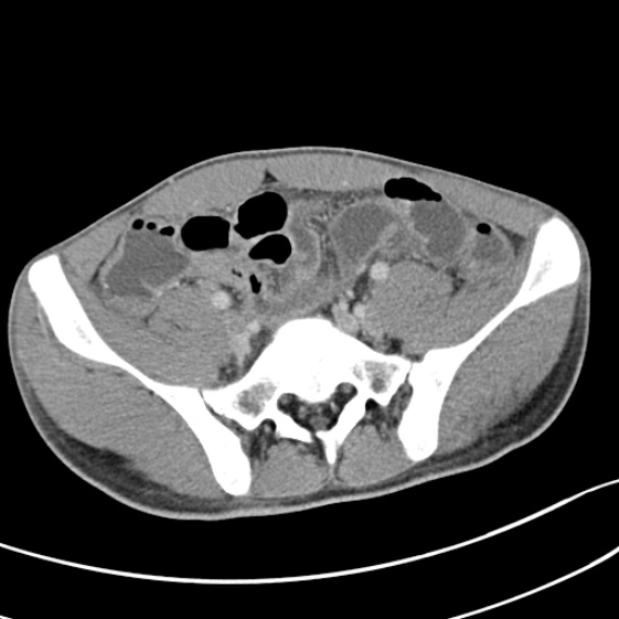 Acute appendicitis (Radiopaedia 32614-33572 Axial C+ portal venous phase 48).jpg