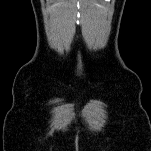 Acute appendicitis (Radiopaedia 38255-40270 Coronal C+ portal venous phase 85).jpg