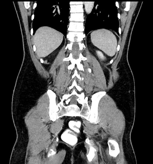 File:Acute appendicitis (Radiopaedia 77016-88960 Coronal C+ portal venous phase 75).jpg
