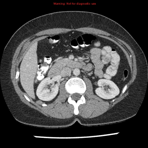 File:Acute appendicitis (Radiopaedia 7966-8812 C+ portal venous phase 15).jpg