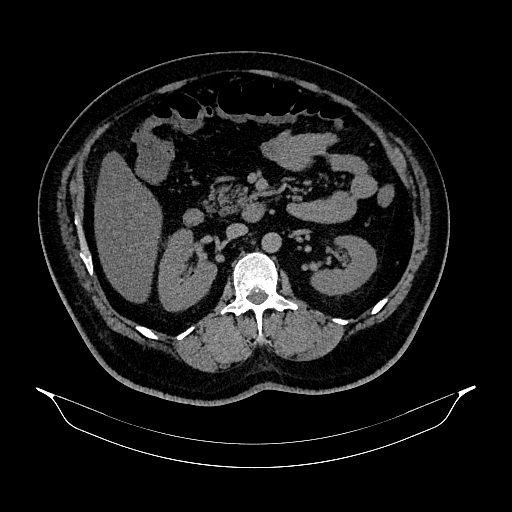Acute appendicitis (Radiopaedia 79950-93224 Axial non-contrast 42).jpg