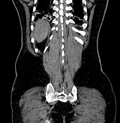 Acute appendicitis (Radiopaedia 79950-93224 Coronal C+ portal venous phase 83).jpg