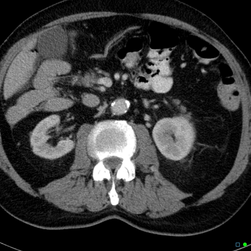 File:Acute appendicitis arising from a malrotated cecum (Radiopaedia 19970-19997 Axial C+ portal venous phase 10).jpg