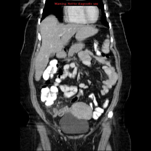 Acute appendicitis complicated by ovarian vein thrombophlebitis (Radiopaedia 16172-15851 Coronal C+ portal venous phase 30).jpg