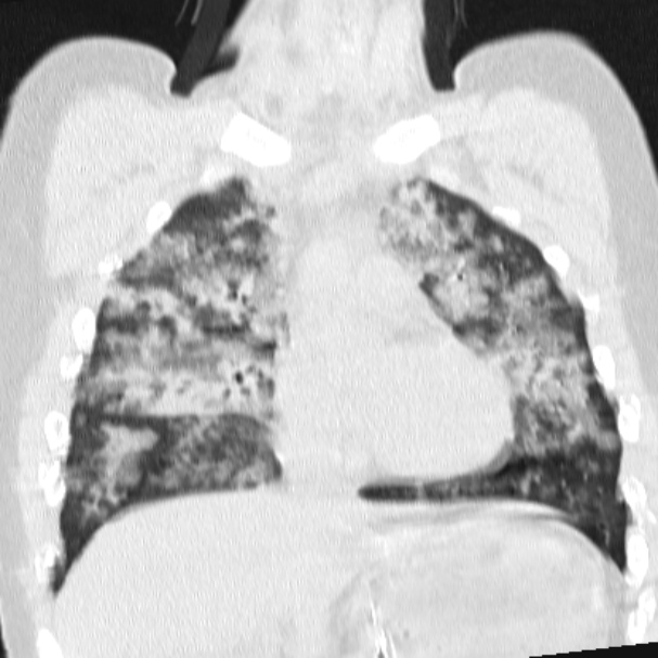 Acute aspiration pneumonitis (Radiopaedia 33605-34703 Coronal lung window 36).jpg