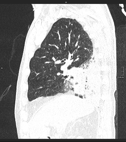 File:Acute aspiration pneumonitis (Radiopaedia 55642-62166 Sagittal lung window 103).jpg