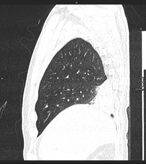 Acute aspiration pneumonitis (Radiopaedia 55642-62166 Sagittal lung window 127).jpg