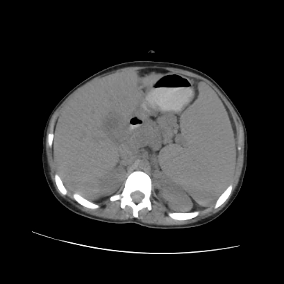 File:Acute calculous cholecystitis in patient with osteopetrosis (Radiopaedia 77871-90159 Axial non-contrast 32).jpg