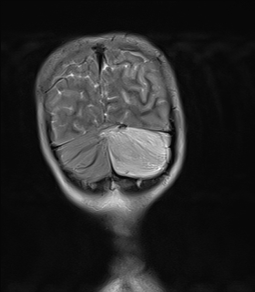 File:Acute cerebellar ataxia (Radiopaedia 61487-69446 Coronal T2 15).jpg