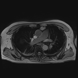 Acute cholecystitis (Radiopaedia 72392-82923 Axial T1 out-of-phase 2).jpg
