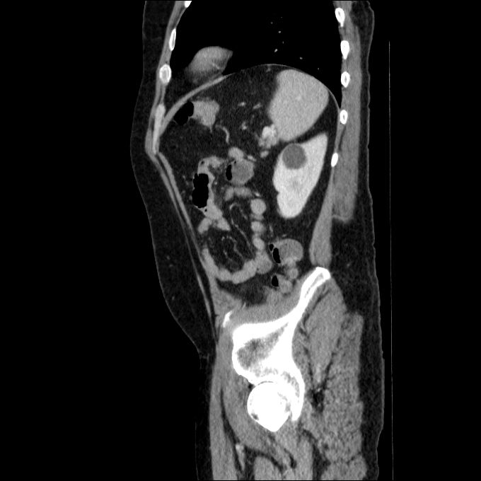 Acute cholecystitis and incidental left sided IVC (Radiopaedia 49352-54459 Sagittal C+ portal venous phase 25).jpg