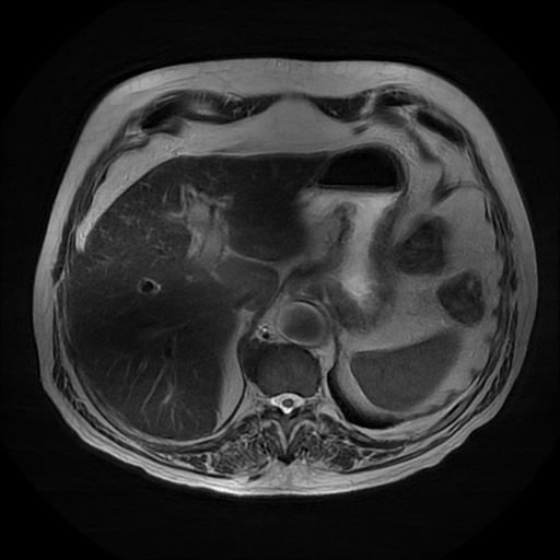 File:Acute cholecystitis complicated by pylephlebitis (Radiopaedia 65782-74915 Axial T2 11).jpg