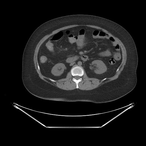 File:Acute cholecystitis with tensile fundus sign (Radiopaedia 71394-81723 Axial non-contrast 37).jpg