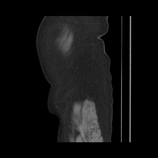 File:Acute cholecystitis with tensile fundus sign (Radiopaedia 71394-81723 Sagittal non-contrast 30).jpg