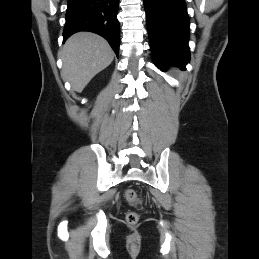 Acute diverticulitis with localized perforation (Radiopaedia 41296-44113 Coronal C+ portal venous phase 49).jpg