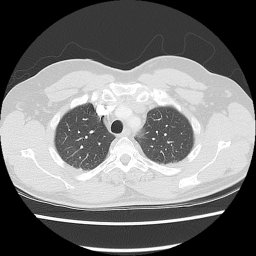 Acute epicardial fat necrosis (Radiopaedia 42327-45440 Axial lung window 17).jpg