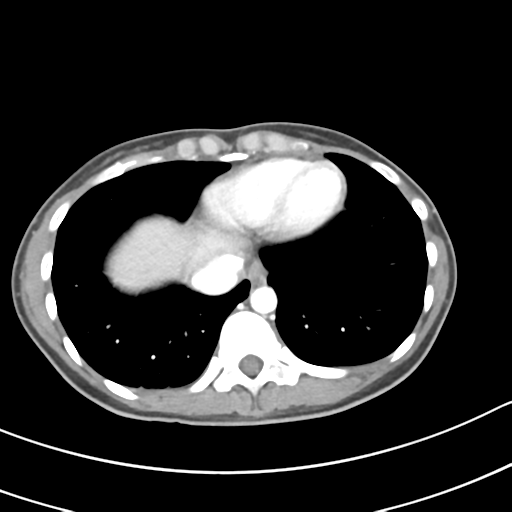 Acute gangrenous appendicitis with perforation (Radiopaedia 40152-42662 Axial C+ portal venous phase 4).png