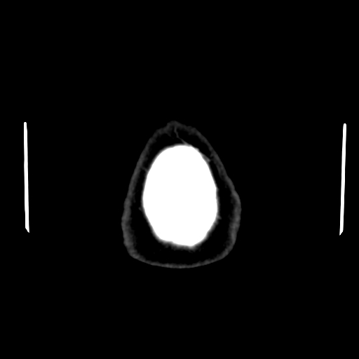 Acute hemorrhagic stroke (Radiopaedia 17507-17223 Axial non-contrast 51).jpg