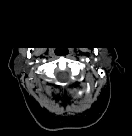 Acute internal carotid artery dissection (Radiopaedia 53541-59630 Axial C+ arterial phase 2).jpg