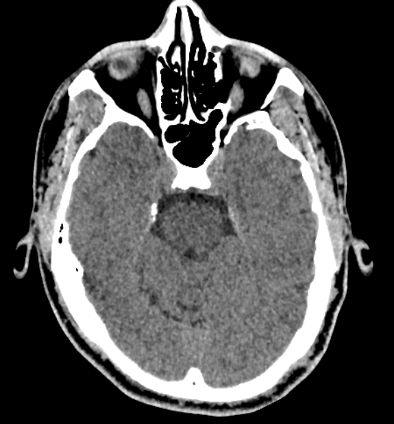 Acute ischemic stroke - posterior circulation territory (Radiopaedia 77670-89881 non-contrast 28).jpg