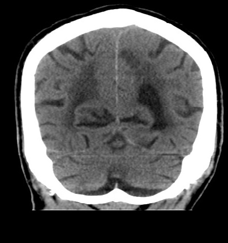 File:Acute left anterior cerebral artery territory infarction (Radiopaedia 51785-57578 Coronal non-contrast 46).jpg