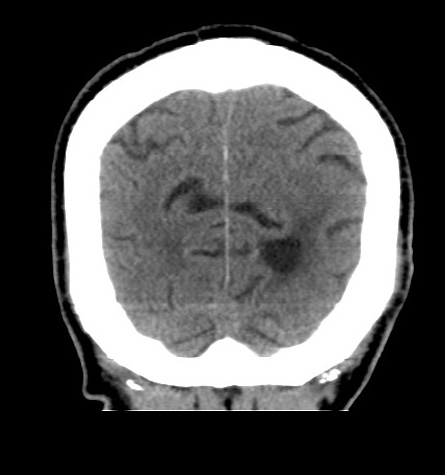Acute left anterior cerebral artery territory infarction (Radiopaedia 51785-57578 Coronal non-contrast 51).jpg