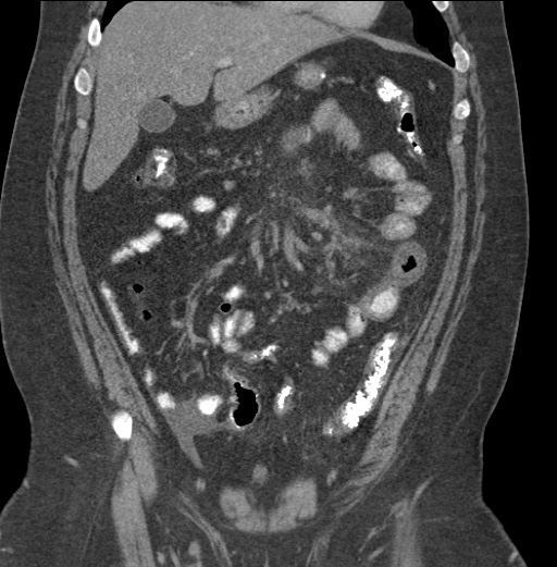 Acute mesenteric venous ischemia (Radiopaedia 46041-50383 Coronal C+ portal venous phase 34).jpg