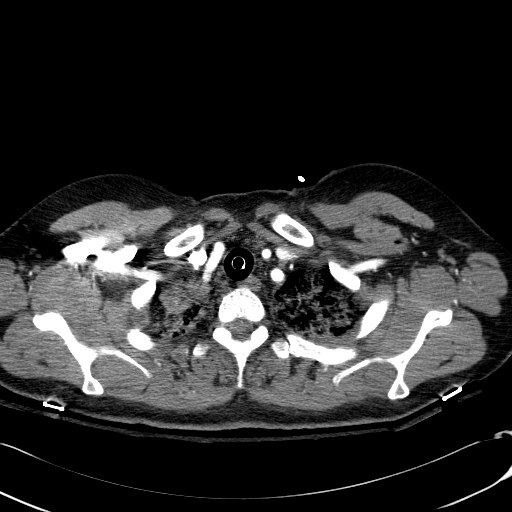 Acute myocardial infarction in CT (Radiopaedia 39947-42415 Axial C+ arterial phase 16).jpg