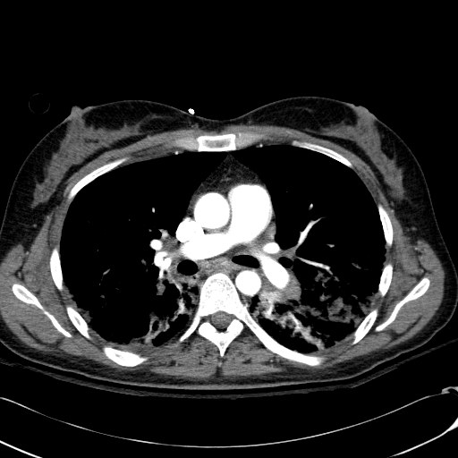Acute myocardial infarction in CT (Radiopaedia 39947-42415 Axial C+ arterial phase 60).jpg