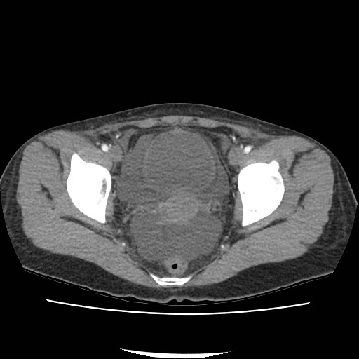 File:Acute myocarditis (Radiopaedia 55988-62613 Axial C+ portal venous phase 73).jpg