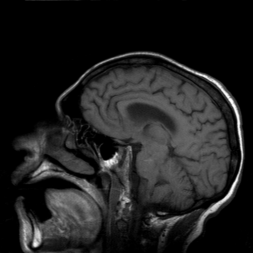 File:Acute necrotizing toxoplasma encephalitis (Radiopaedia 10683-11149 Sagittal T1 fat sat 11).jpg