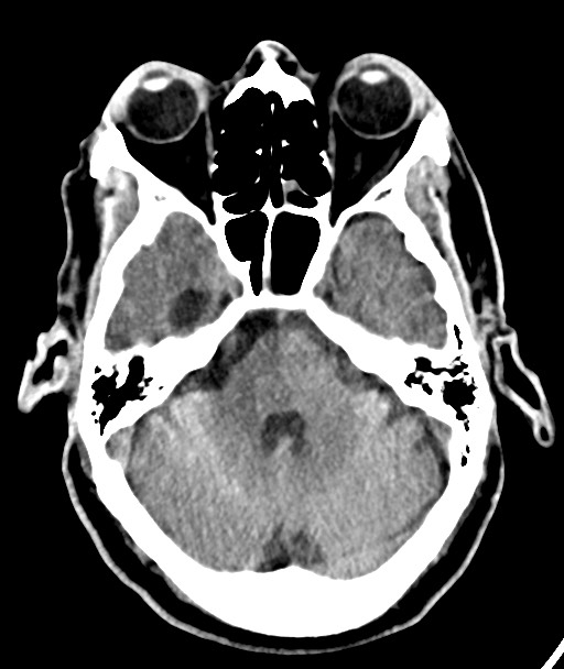 Acute on chronic subdural hematoma (Radiopaedia 78346-90966 Axial non-contrast 22).jpg
