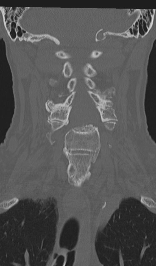 Acute on chronic subdural hematoma and thoracic vertebral injury in a multitrauma patient (Radiopaedia 31698-32619 Coronal bone window 29).jpg
