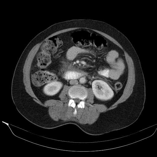 File:Acute pancreatitis (Radiopaedia 20829-20744 Axial C+ portal venous phase 25).jpg