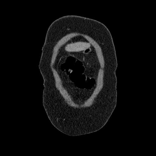 File:Acute pancreatitis (Radiopaedia 20829-20744 Coronal C+ portal venous phase 5).jpg